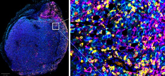 AOAH not only demonstrates standalone therapeutic potential but also functions as a powerful complement to existing immunotherapies, providing a promising strategy to overcome immune resistance in advanced cancers by potentiating infiltration and activation of CD8+ T cells and CD11c+ dendritic cells.
 